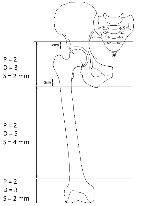 Diagram of the femur showing the three CT scan regions and their pitch, detector collimation and slice thickness settings